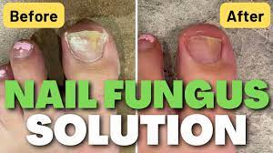 natural nail fungus solution see