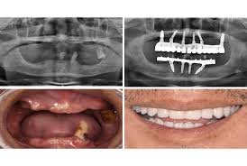 full mouth dental implants definition