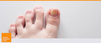 cost of toenail fungus laser treatment