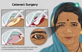 cataract surgery procedure purpose
