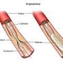 CORONARY STENTS AND HEALTH HEALTH from www.hopkinsmedicine.org