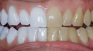 Resultado de imagem para dentes brancos