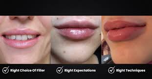 natural lip fillers the art of