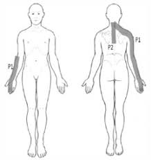 Body Chart Showing The Location Of Symptoms P1 Neck Pain