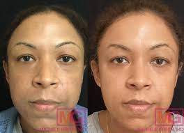 microneedling for acne scars dr