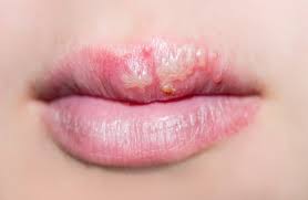 what is the herpes simplex virus hsv