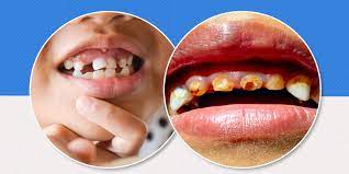 tooth decay in children causes