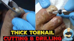 how to fix a thick damaged toenail in 5