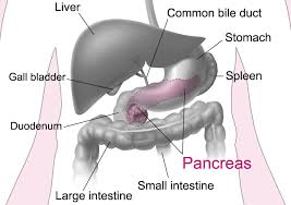 pancreatic cancer types and general