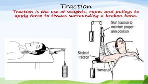 Traction is a set of mechanisms for straightening broken bones or relieving pressure on the spine and skeletal system. Nursing Management Of Patients In Traction