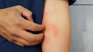 eczema causes symptoms and treatments