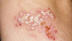 They do not refer to where the infection occurs. Herpes Simplex Virus 1 2 Clinical Advisor