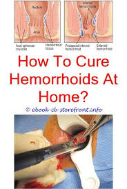 The unqualified term hemorrhoid is often used to refer to the disease. Pin Na Doske How To Get A Hemorrhoid Back In