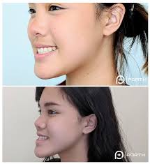 jaw surgery and orthodontic treatment