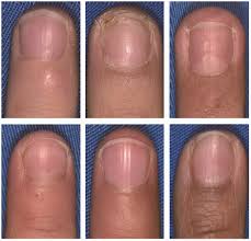 paediatric fingernail avulsion injuries