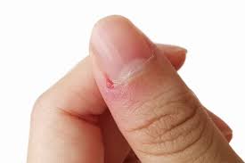 ingrown fingernail treatment at home