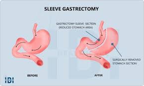 gastric sleeve weight loss timeline