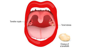 what are tonsil stones causes