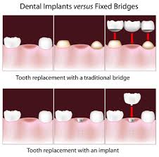 dental bridge vs implant an in depth