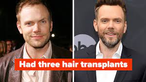 male celebs discuss hair transplants