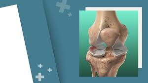 physical therapy for knee meniscus tear