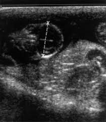 Fetal Biparietal Diameter Bpd Gestation 35 Days Bpd