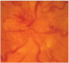 What are the symptoms of anterior ischemic optic neuropathy? Ophthalmologist Boston Naion Boston Neec