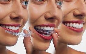 Braces are still the most common way to straighten teeth and are this process, also called tooth reshaping, involves removing small amounts of tooth enamel to reshape teeth that overlap or stick out. Trisa Dental Solutions Smile Enhancement Without Braces