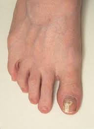 treating toenail fungus
