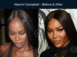 21 black celebrity hair transplants