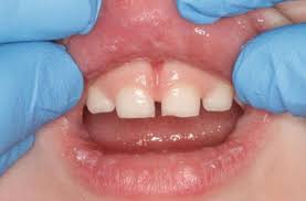 dento alveolar trauma in the primary