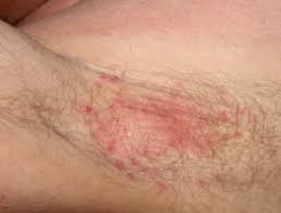 Jul 11, 2021 · intertrigo is an inflammatory rash that occurs between skin folds as a result of friction, moisture, and lack of airflow. Intertrigo Dermnet Nz