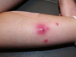 MRSA SKIN INFECTION SIGNS AND SYMPTOMS: