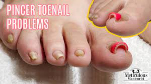 pedicure tutorial on pincer toenails