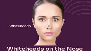 whiteheads on the nose causes