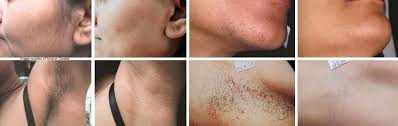 Results will vary from person to person. Laser Hair Removal Coastal Valley Dermatology