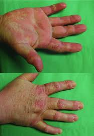 Restlessness and unable to sleep. The Itching Hand Important Differential Diagnoses And Treatment Weisshaar 2013 Jddg Journal Der Deutschen Dermatologischen Gesellschaft Wiley Online Library