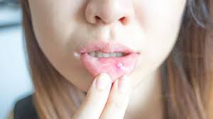 canker sores symptoms and diagnosis
