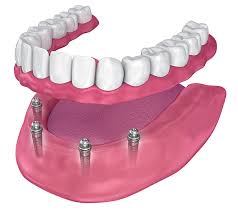 abbadent dental and implants