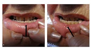 biting fibroma of the lower lip