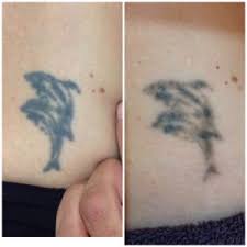 You are an ideal candidate for laser tattoo removal! Laser Tattoo Removal Skin Alert Cairns
