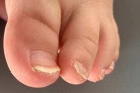 treatments for fungus on toenails and