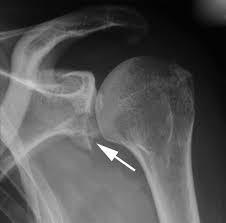 Kürek kemiği olarak da bilinen skapula, üst vücutta yer alan en büyük kemiklerden bir tanesidir. Kurek Kemigi Kirigi Nasil Tedavi Edilir Tedavisi Ve Iyilesme Sureci