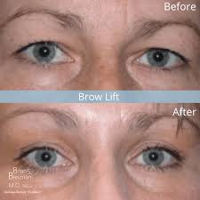 blepharoplasty vs brow lift which is