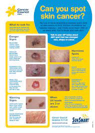 Melanoma is one type of skin cancer. Spot The Difference Between A Mole Or Melanoma Kinesys Performance Sunscreen Australia