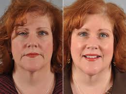 ptosis droopy eyelid surgery before and