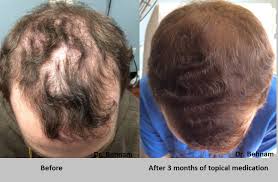 topical finasteride for hair growth