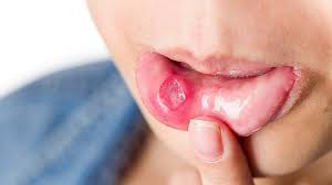 An mundfäule erkranken meist kinder. Herpes Im Mund Was Kann Man Dagegen Tun Zava Dred