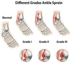 how to get your ankle sprain better