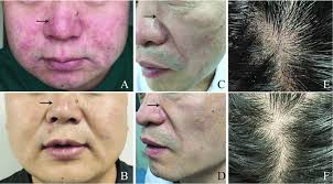 images showing the skin lesions